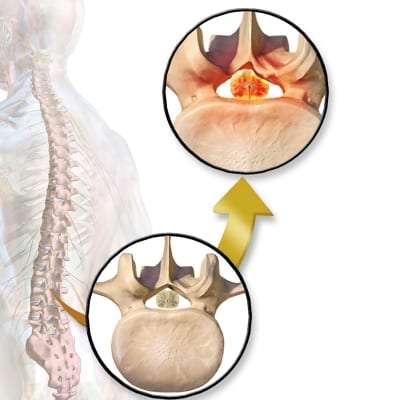 Pain Managment for Spinal Stenosis in Lakeland, Florida