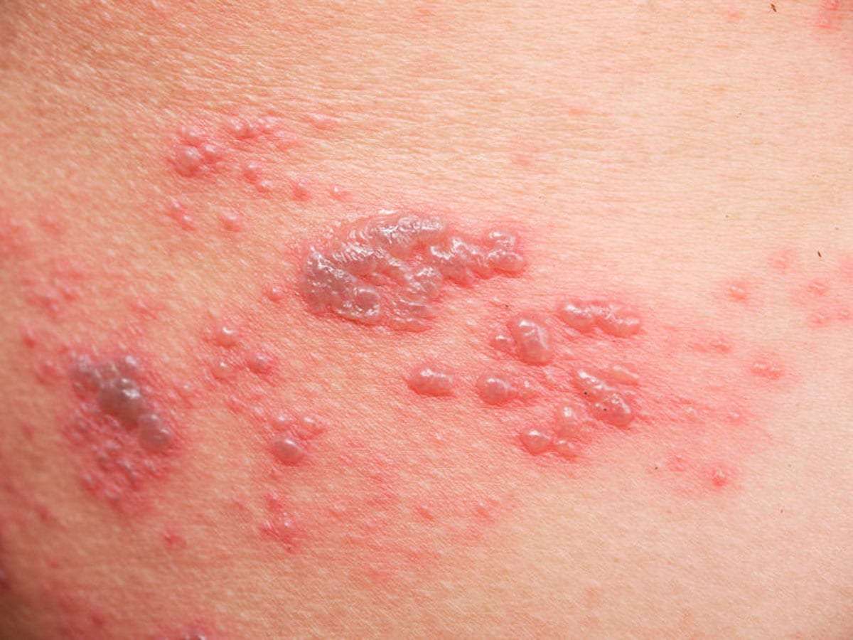 shingles on leg