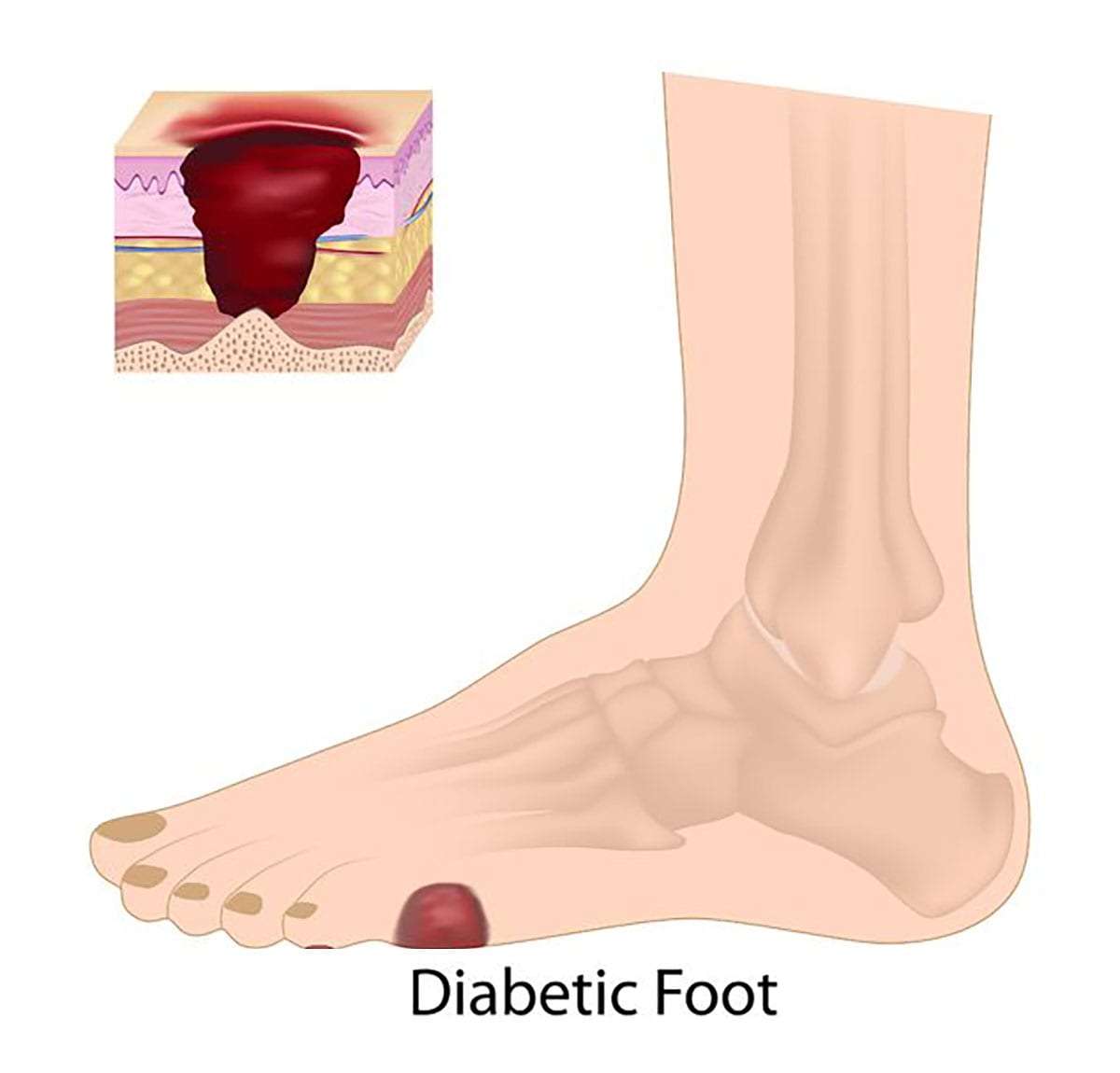 diabetic neuropathy symptoms in feet