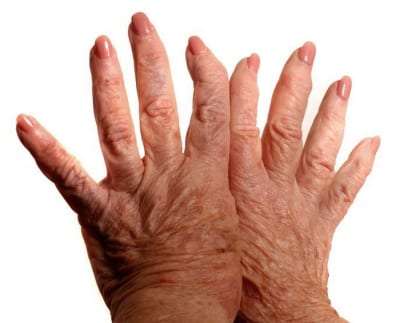 Pain Management of Arthritis in Lakeland, Florida