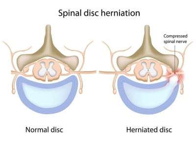 Pain Management for a herniated disc in Lakeland, Florida