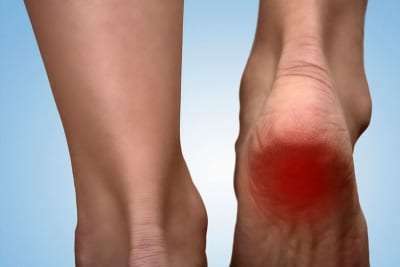 Pain Management for heel spur pain in Lakeland, Florida
