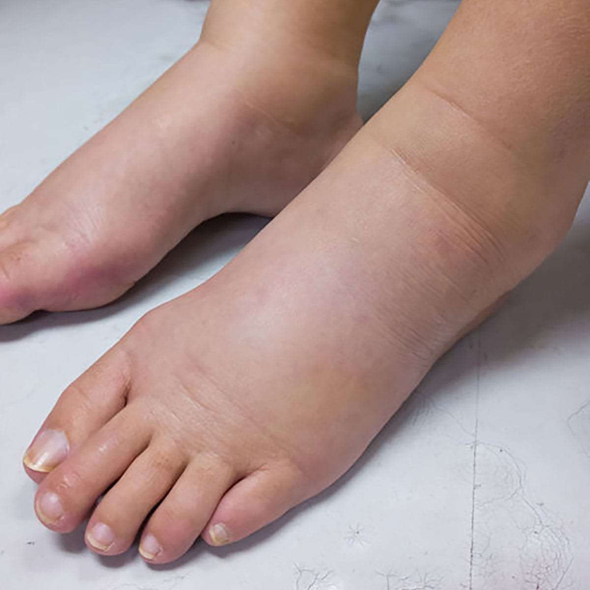 Edem alergic al genunchiului. Ce antibiotice să bea pentru durere în articulații
