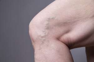 Novus Spine & Pain Center vein clinic treatment of spider veins