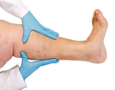 Pain Management for Venous Insufficiency in Lakeland, Florida