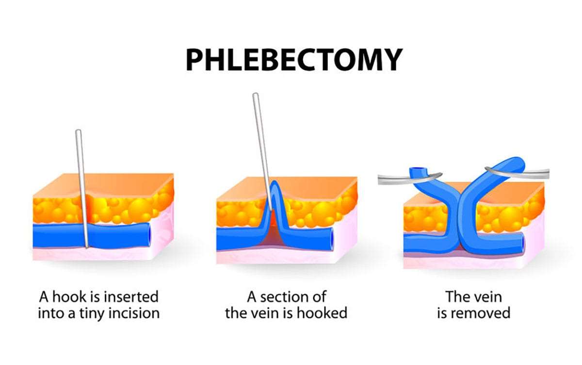 phlebectomy wikipedia)