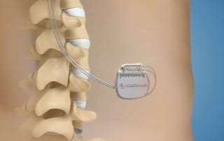 Pain Management Treatment with Spinal Cord Stimulation in Lakeland, Florida