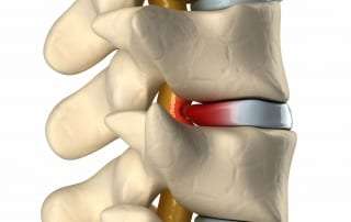 Non-Surgical Pain Management Treatments for bulging disc in Lakeland, Florida