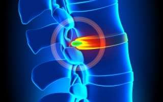 Pain management for herniated disc in Lakeland, Florida