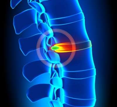 Pain Management Techniques for a Herniated Disc in Lakeland, Florida