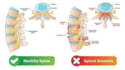 Pain Management for Spinal Stenosis in Lakeland, Florida
