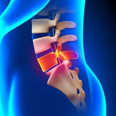 Lumbar discectomy back pain treatment in Lakeland, Florida
