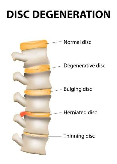 Minimally Invasive Lumbar Discectomy for back pain in Lakeland, Florida