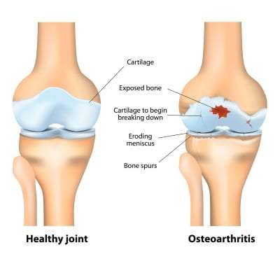 Pain Management for Osteoarthritis in Lakeland, Florida