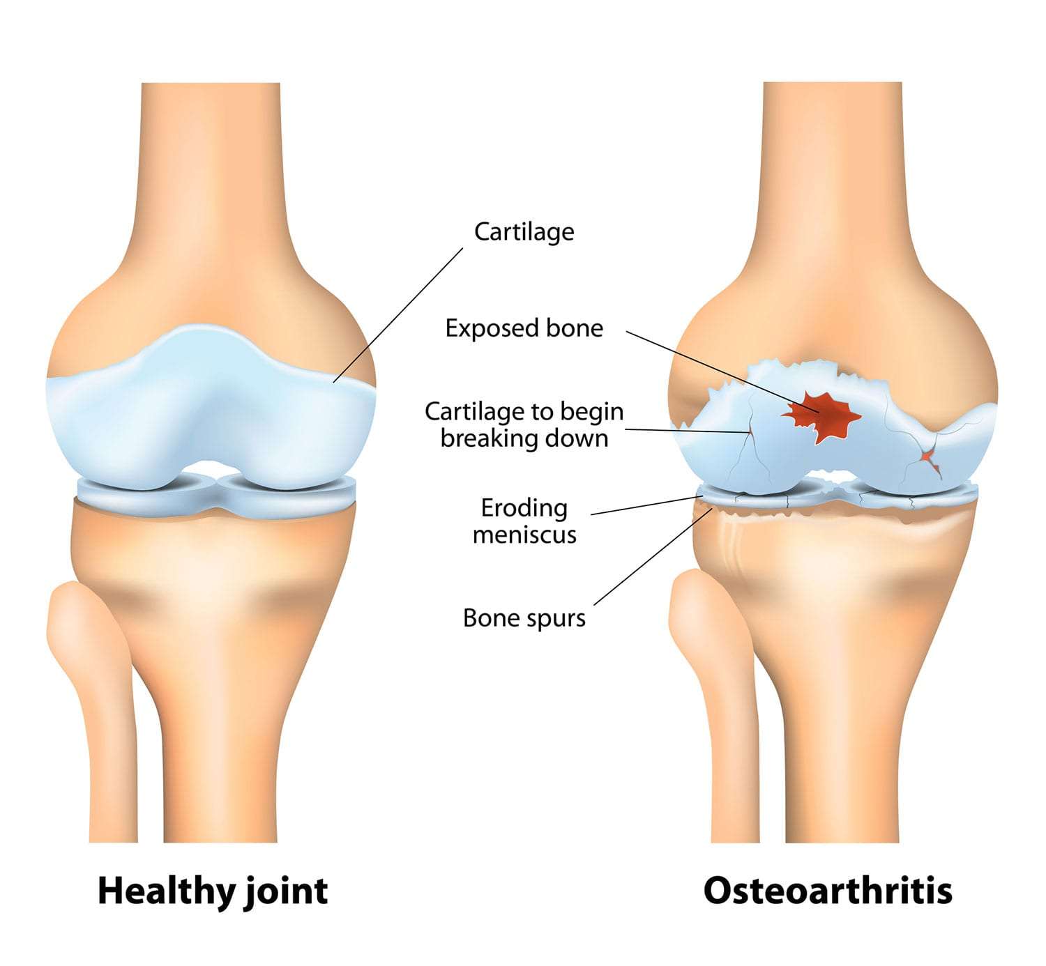 Arthritis or arthrosis - that is the question? An overview of concept in osteoarthritis.