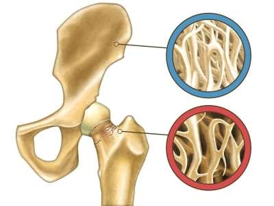 Pain Management for Osteoporosis in Lakeland, Florida