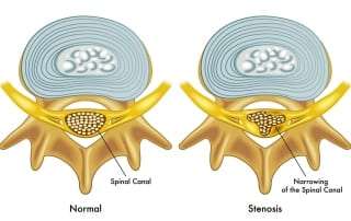 Pain treatment for Spinal Stenosis in Lakeland, Florida
