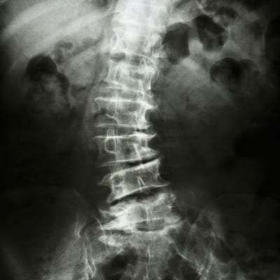 Pain Management for Scoliosis in Lakeland, Florida
