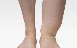 Causes, treatments, and prevention of Edema in Lakeland, Florida