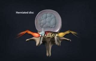Pain Management for a herniated disc in Lakeland, Florida