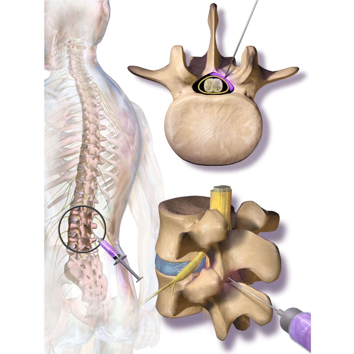 Epidural Steroid Injections Novus Spine & Pain Center