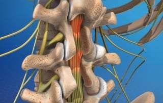 Post-Laminectomy Syndrome in Lakeland, Florida