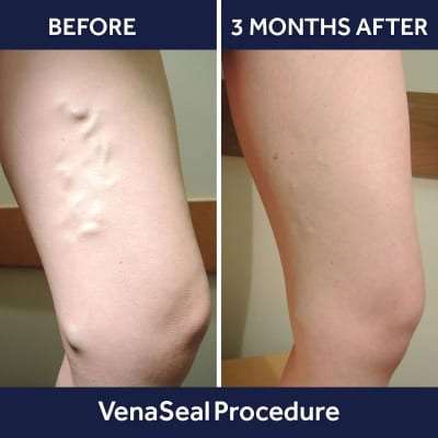 VenaSeal Procedure for Varicose Veins in Lakeland, Florida