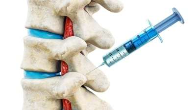 facet injection treatment in Lakeland, Florida