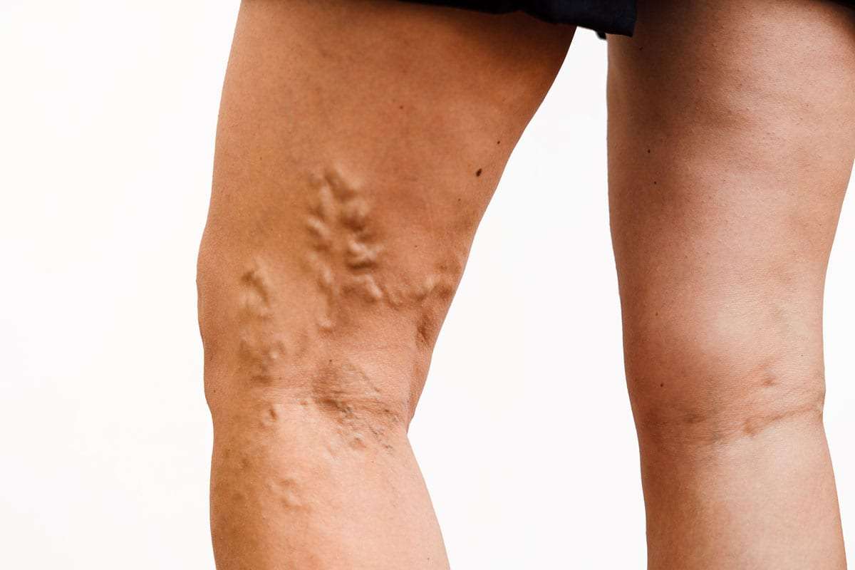 Cum se tratează varicele de pe picioare acasă - Sulf pentru vene varicoase