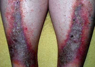 Treating Stasis Dermatitis in Lakeland, Florida