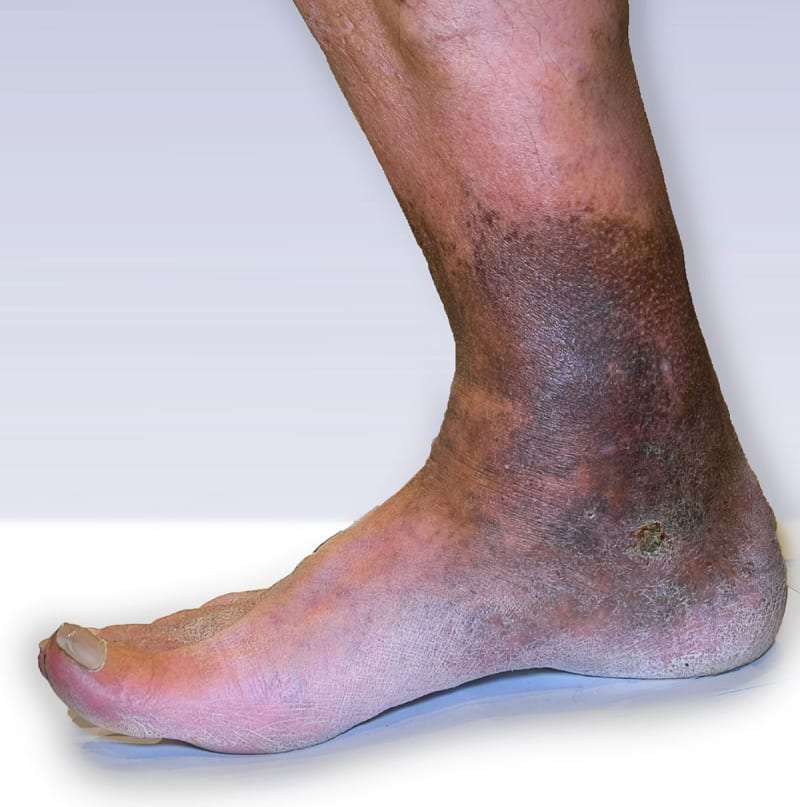 Venous Insufficiency Causes Symptoms And Treatment