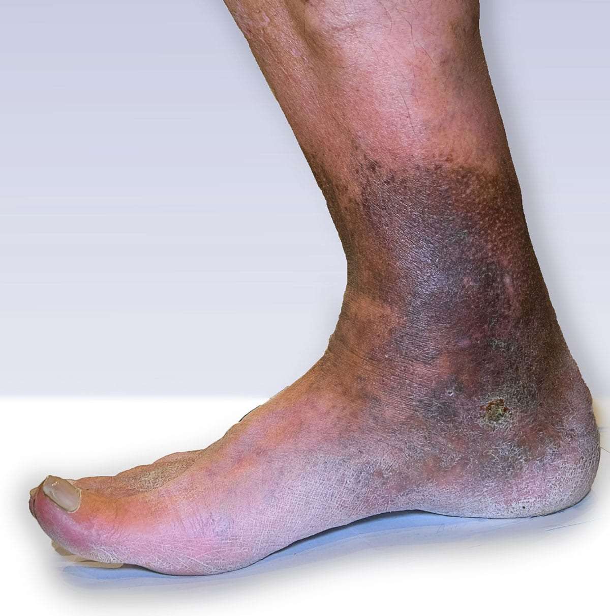 venous stasis foot swelling