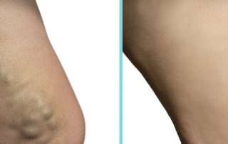 Varicose veins before and after treatment with RF ClosureFast in Lakeland, Florida