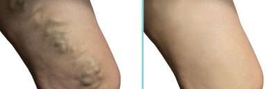 Varicose veins before and after treatment with RF ClosureFast in Lakeland, Florida