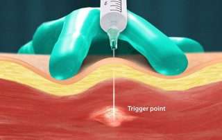 Trigger Point Injections for pain management in Lakeland, Florida