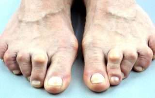 Treating Rheumatoid Arthritis of the Foot and Ankle in Lakeland, Florida