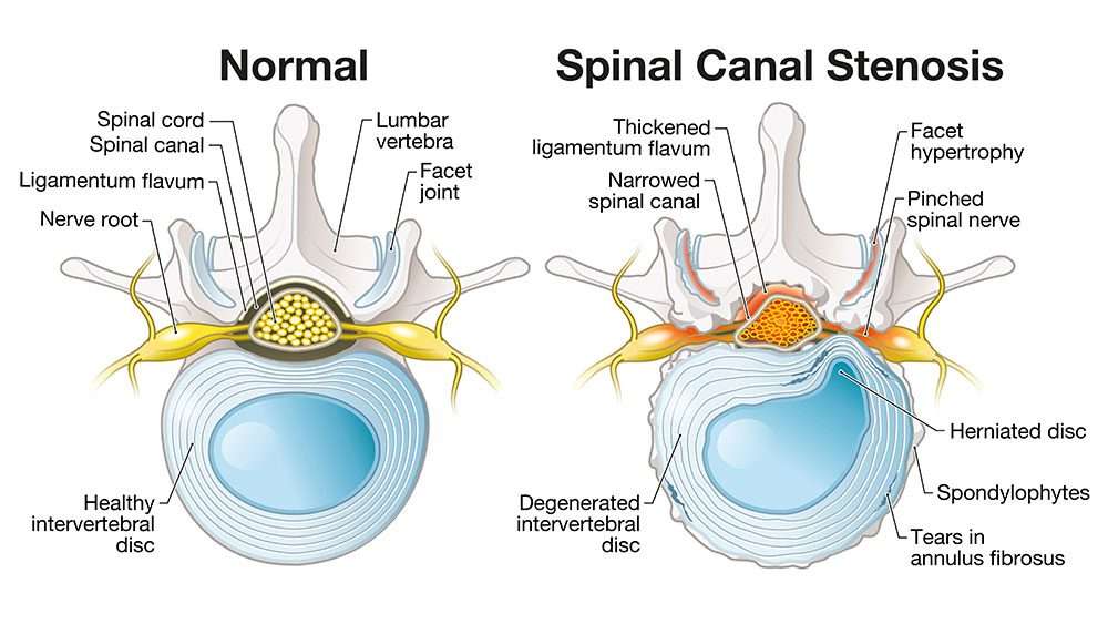 MILD Procedure for Spinal Stenosis