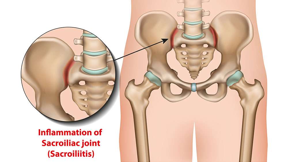 Sacroiliac Joint Injections in Lakeland, Florida